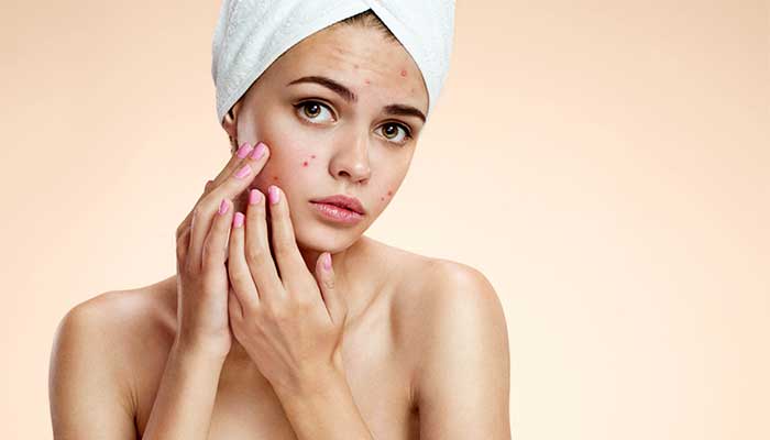 Laser Acne Treatments